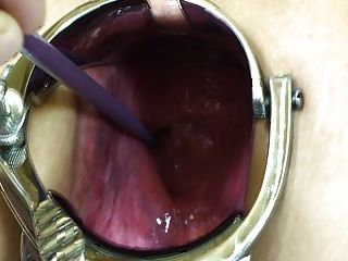 Elmer Wife Extreme Anal Speculum Play